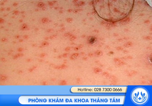 dấu hiệu giang mai ở nữ giới