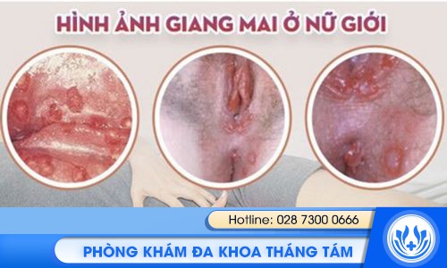dấu hiệu bạn đầu của bệnh giang mai