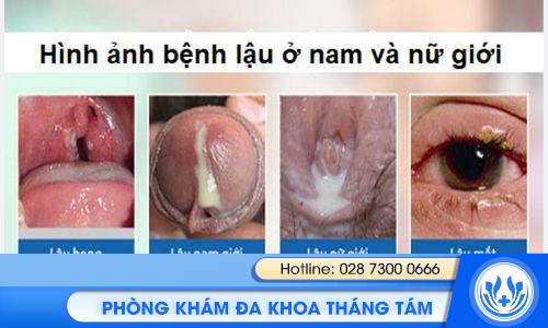 biểu hiện ban đầu của bệnh lậu là gì?