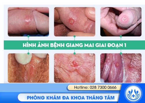 tổng quan bệnh giang mai