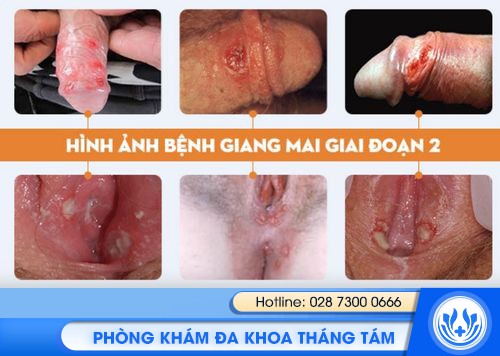 tổng quan bệnh giang mai