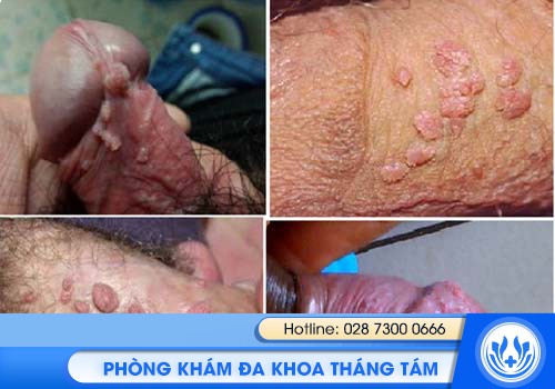 mụn thịt trên thân dương vật