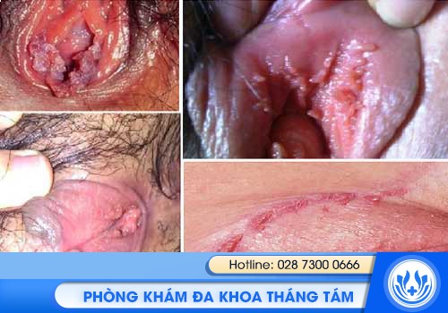 sùi mào gà ở nữ