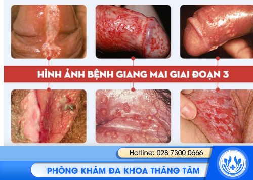tổng quan về bệnh giang mai
