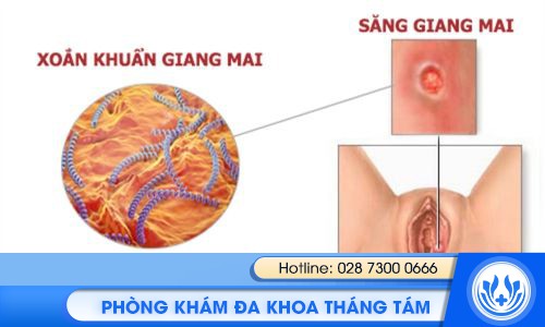 dấu hiệu giang mai ở nữ giới