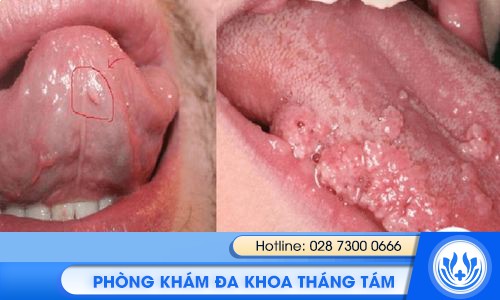 lưỡi nổi mụn có sao không