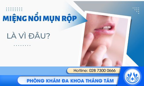 miệng nổi mụn rộp