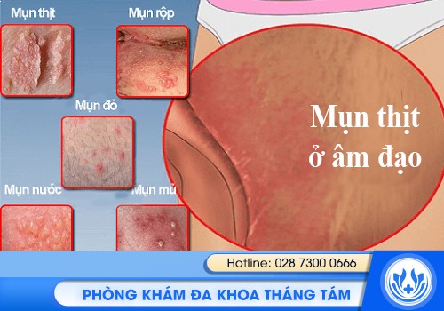 mụn thịt ở âm đạo