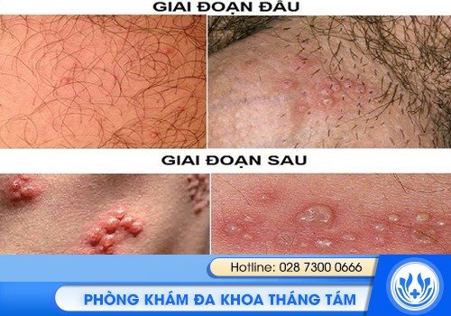 mụn rộp sinh dục