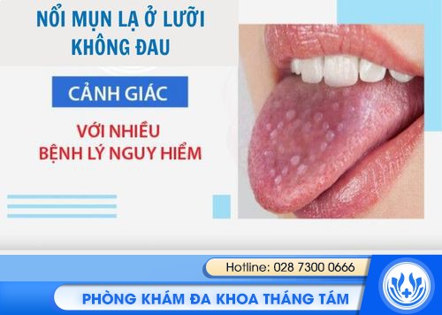 nổi mụn lạ ở lưỡi không đau
