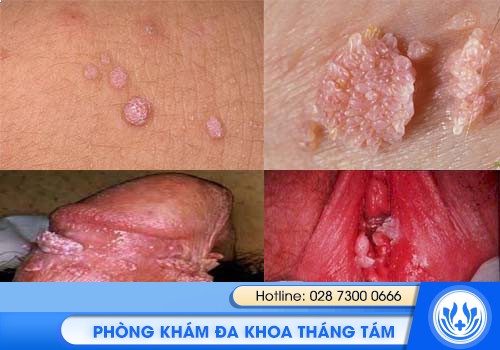 tại sao lại nổi mụn vùng kín