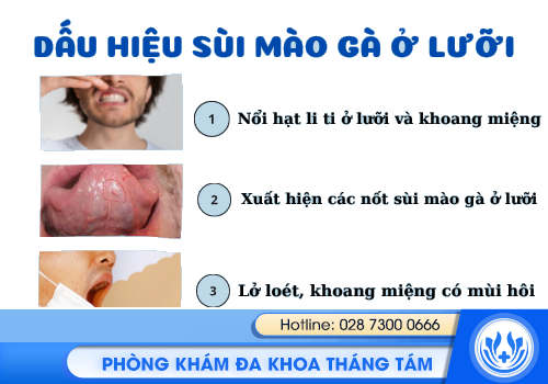 sùi mào gà ở lưỡi