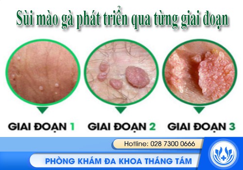 Tổng Quan Về Bệnh Sùi Mào Gà Nguy Hiểm Lây Truyền Qua Đường Tình Dục