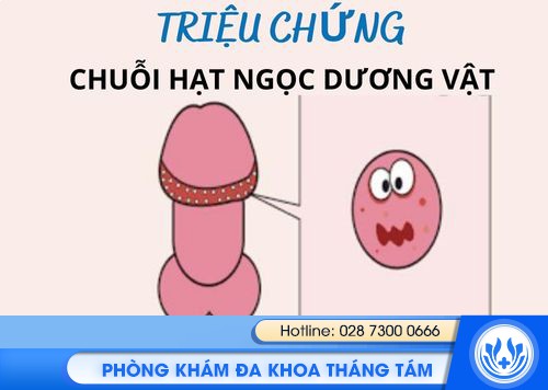 chuỗi hạt ngọc ở dương vật