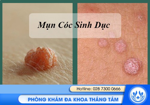 dương vật nổi mụn do đâu